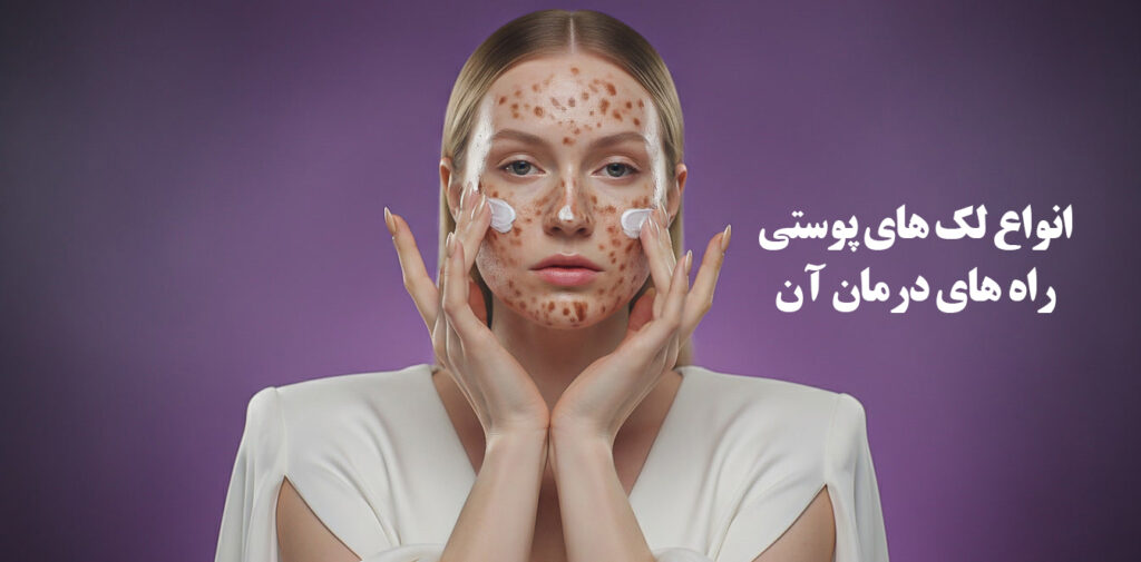 لک‌های پوستی و روش‌های درمان آن‌ها